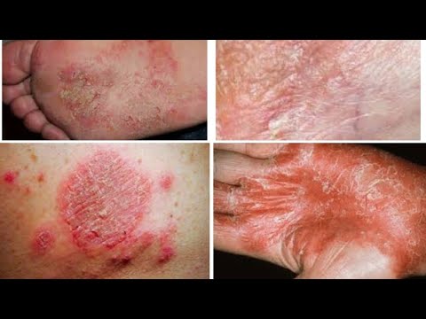 Receta casera para curar el eczema